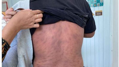 Prevalensi Kusta di Sulawesi Barat Masih Tinggi, Dinkes Perkuat Deteksi Dini dan Pengobatan